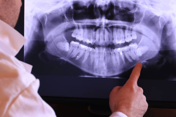 Best Emergency Treatment for Dental Infections or Abscesses in Clifton, NJ